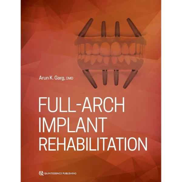 Full-Arch Implant Rehabilitation