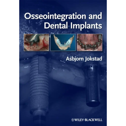Osseointegration and Dental Implants Osseointegration and Dental Implants