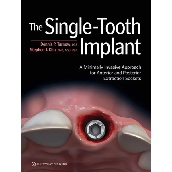 The Single-Tooth Implant