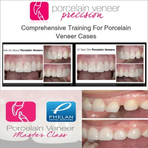 Porcelain Veneer Precision: Comprehensive Training for Porcelain Veneer Cases