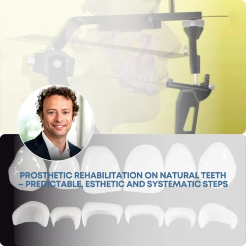 gIDEdental Prosthetic Rehabilitation on Natural Teeth: Predictable, Esthetic and Systematic Steps